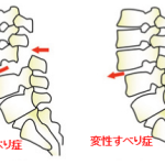 すべり症の症状について手術の前に鍼灸という治療法