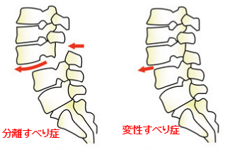 すべり症の症状について手術の前に鍼灸という治療法