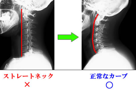 ストレートネック原因は昼の○○、治し方は寝る前５分○○で改善