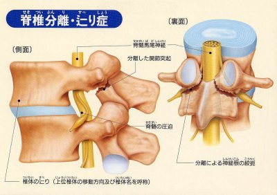 腰椎分離症　引用