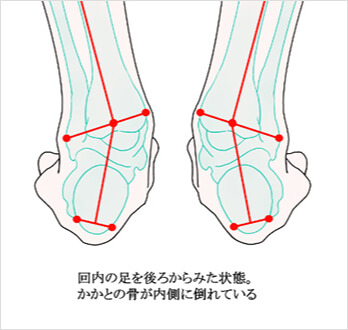 かかと　回内　引用