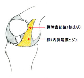 タナ障害　引用