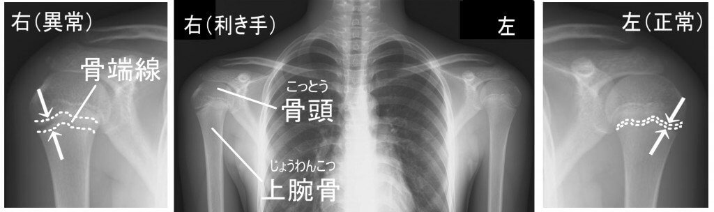 野球肩　骨端線　引用