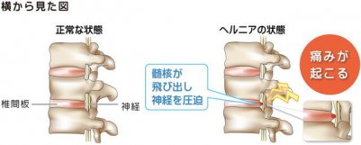 椎間板ヘルニア　引用