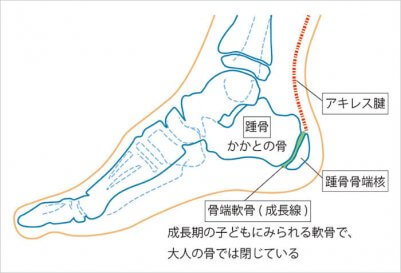 踵骨骨端症（しょうこつこったんしょう）やシーバー病　　引用