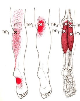 腓腹筋トリガーポイント