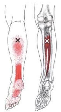 後脛骨筋トリガーポイント