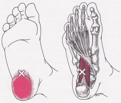足底方形筋トリガーポイント