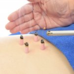 お灸の効果はいつから?【鍼灸師が解説】即効性がないと思ってる?関節痛にお灸がヤバい