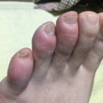 しもやけを鍼灸治療で改善した話