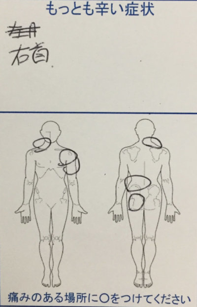 右首・左肩・左腰～おしりの痛みがスポーツをするとすぐ痛む女性40代の一症例