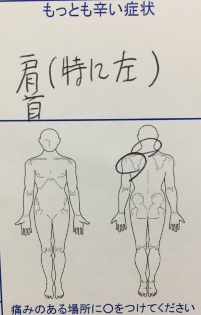 左肩こりが１年ほど辛く整体鍼灸治療で改善した一症例