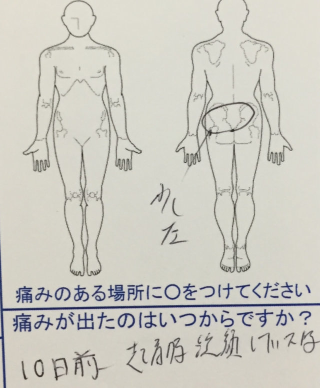 朝起きて洗顔中に腰が痛くなり10日経っても治らない腰痛の一症例