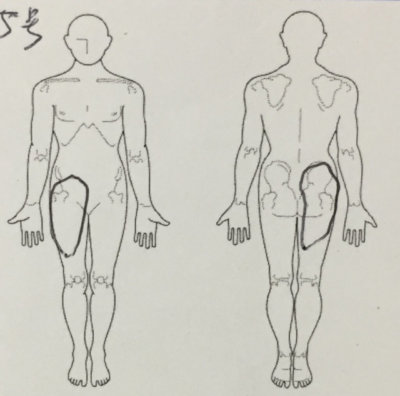 腰痛で整形外科受診→L5ヘルニアと言われた30代男性が改善した一症例