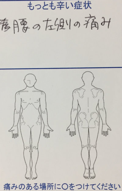 腰の左側の痛み【立ち上がる時、歩く時】を整体と鍼同時治療で改善した1症例