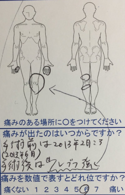 足のこわばりと手のしびれ【手術後の後遺症】力が入り、足のつっぱり感が薄れた１症例