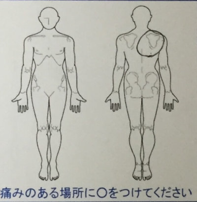 3日前から肩から肩甲骨が凝って痛い【20代男性】整体治療で改善した1症例