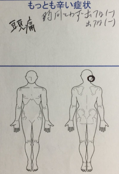 頭痛が辛い【元々首腰肩の痛みあり】整体鍼灸治療で改善した1症例