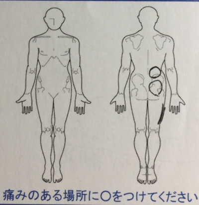 右足とお尻から腰が痛い【昨日から突然】40代女性、整体鍼灸治療で改善した1症例