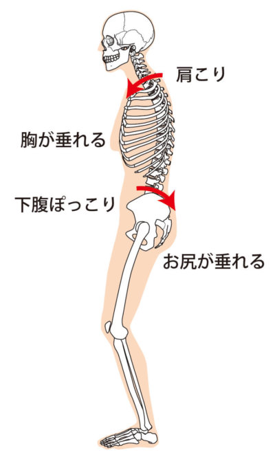 骨盤後傾（猫背）