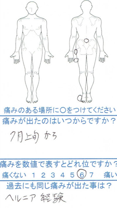 ヘルニア経験ありで腰痛【左足しびれあり】坐骨神経痛の1症例