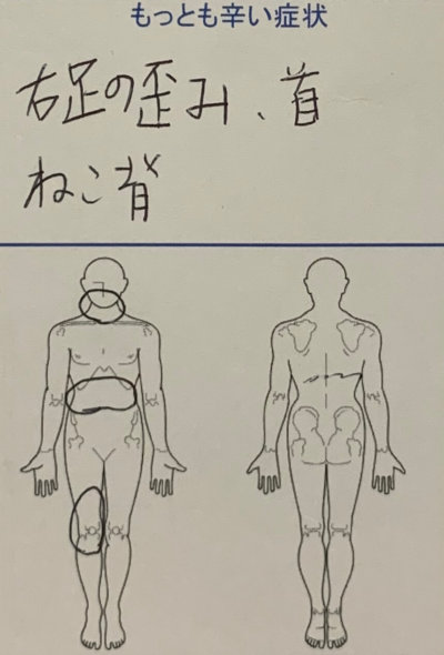 右足の歪み、首こり、ねこ背【ストレッチで違和感】30代女性の1症例