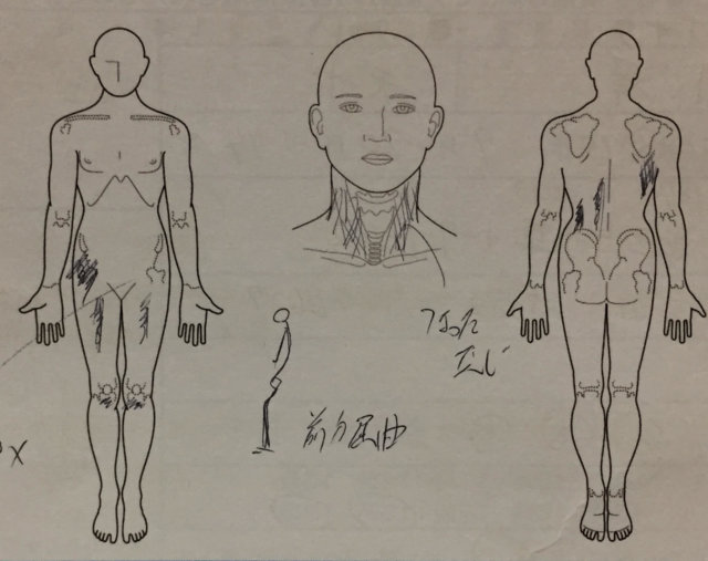 10代膝の痛み【成長痛？】膝から腰、腕まで痛かった1症例