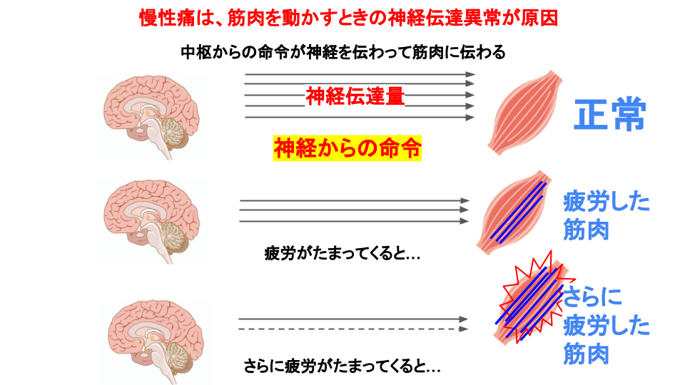 慢性痛は、筋肉を動かすときの神経伝達異常が原因