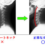 ストレートネック原因は昼の○○、治し方は寝る前５分○○で改善