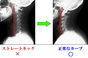 ストレートネック原因は昼の○○、治し方は寝る前5分○○で改善